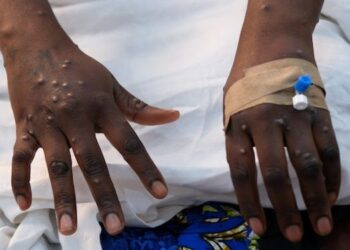 Ghana records 21 new Mpox cases, total now 218 – GHS
